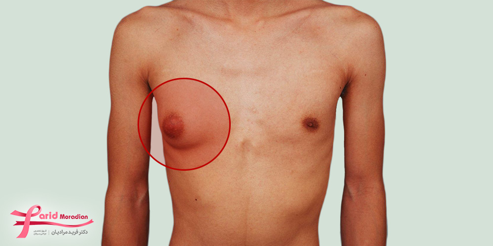 علائم رایج ژنیکوماستی در افراد