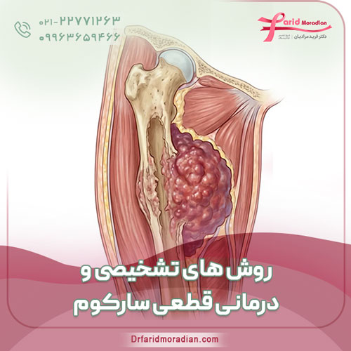روش‌ های تشخیصی و درمانی قطعی سارکوم