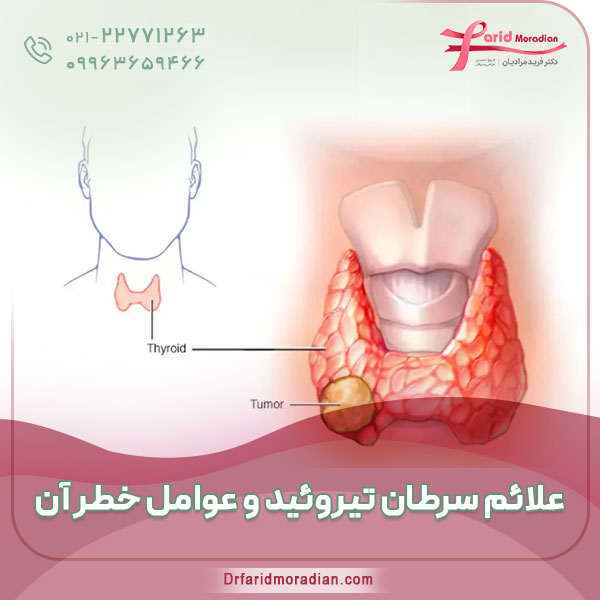 علائم سرطان تیروئید و عوامل خطر آن علائم سرطان تیروئید و عوامل خطر آن