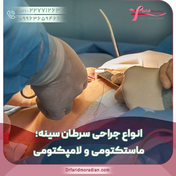 انواع جراحی سرطان سینه؛ ماستکتومی و لامپکتومی انواع جراحی سرطان سینه؛ ماستکتومی و لامپکتومی