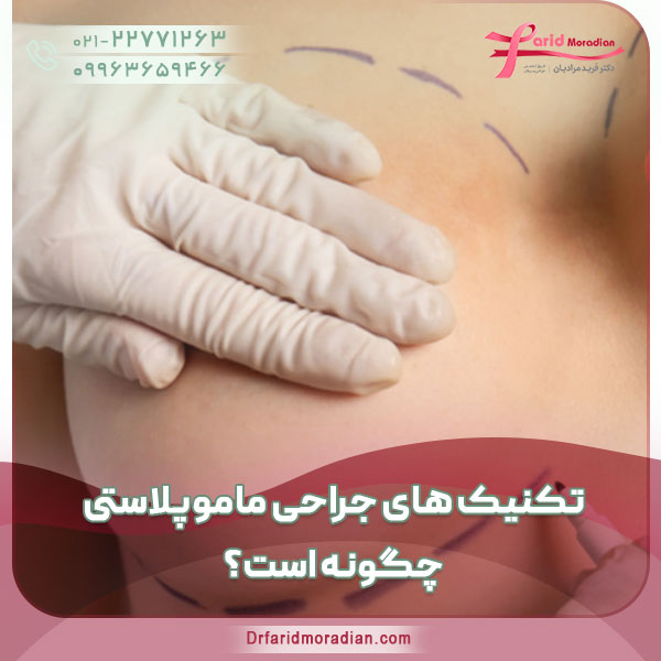 تکنیک های جراحی ماموپلاستی چگونه است؟ تکنیک های جراحی ماموپلاستی چگونه است؟